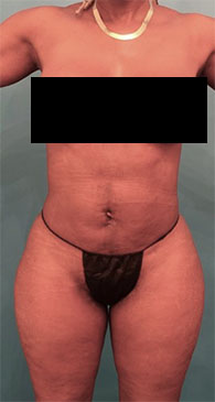 Liposuction before and after - after