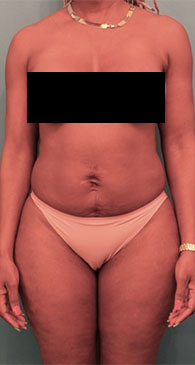 Liposuction before and after - before