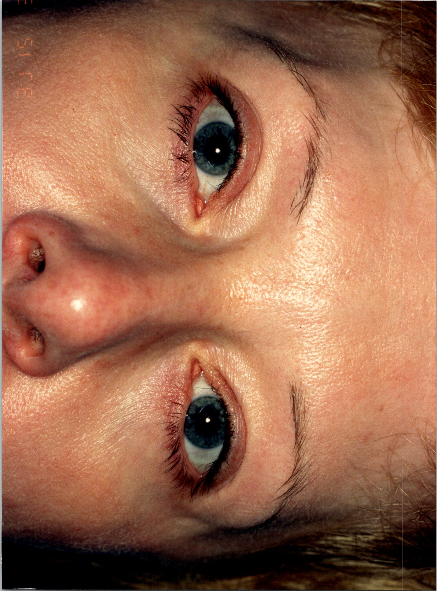 Brow Lift after — Dr. Sayed Mirrafati
