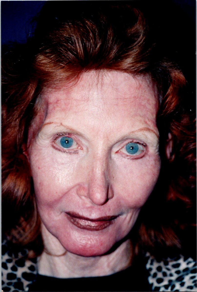 Brow Lift before — Dr. Sayed Mirrafati