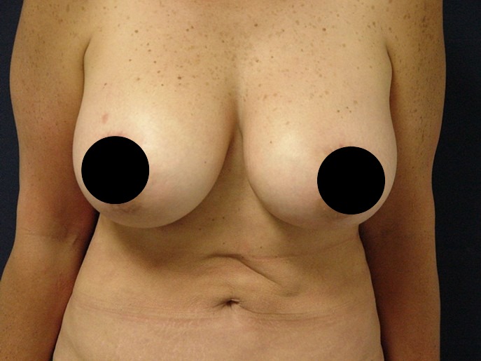 Breast Reduction before and after - before