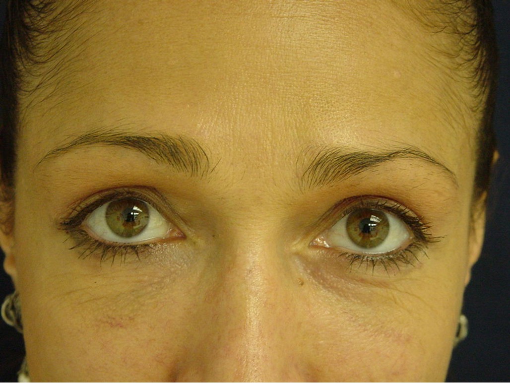 Eyelid Surgery before — Dr. Sayed Mirrafati