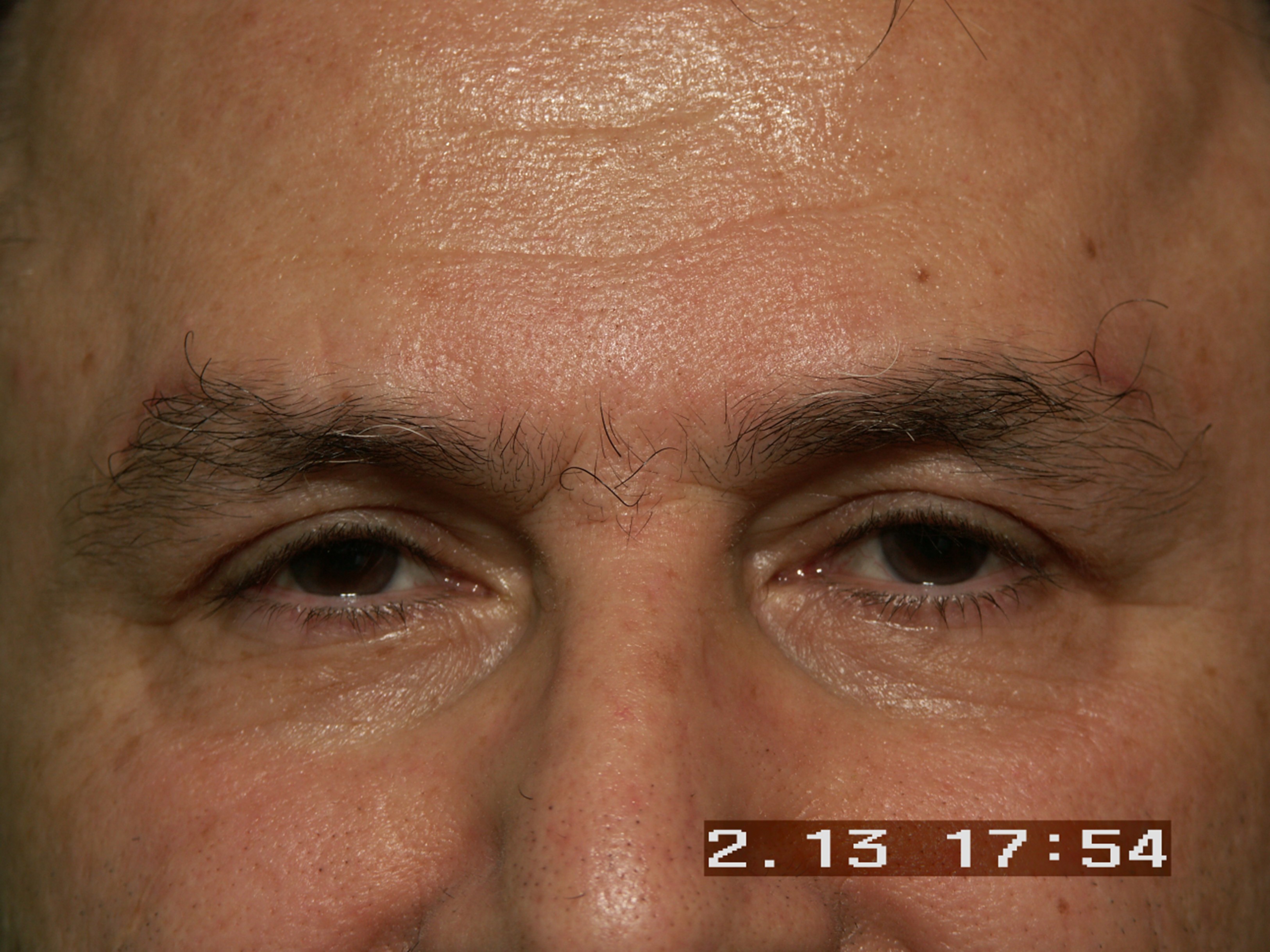 Eyelid Surgery after — Dr. Sayed Mirrafati