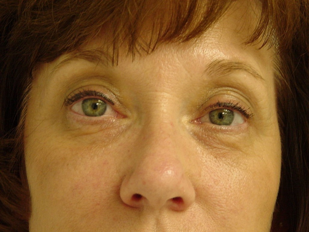 Eyelid Surgery before — Dr. Sayed Mirrafati