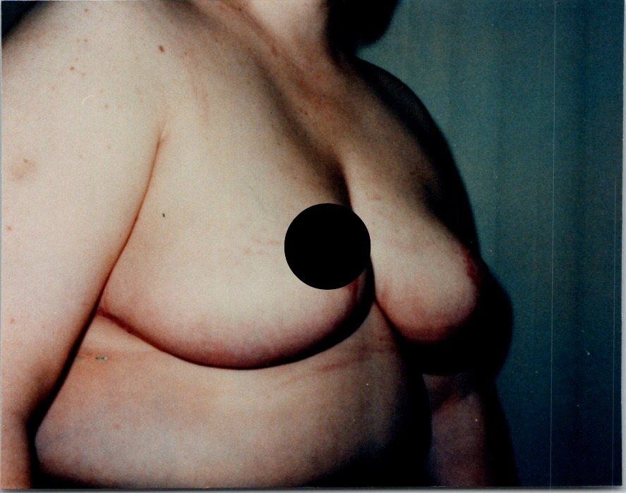 Breast Reduction before and after - before