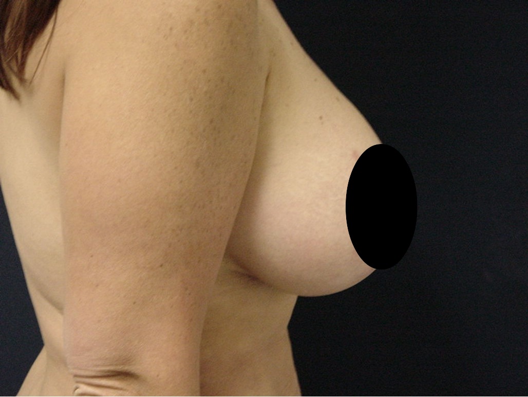 Breast Lift before and after - after