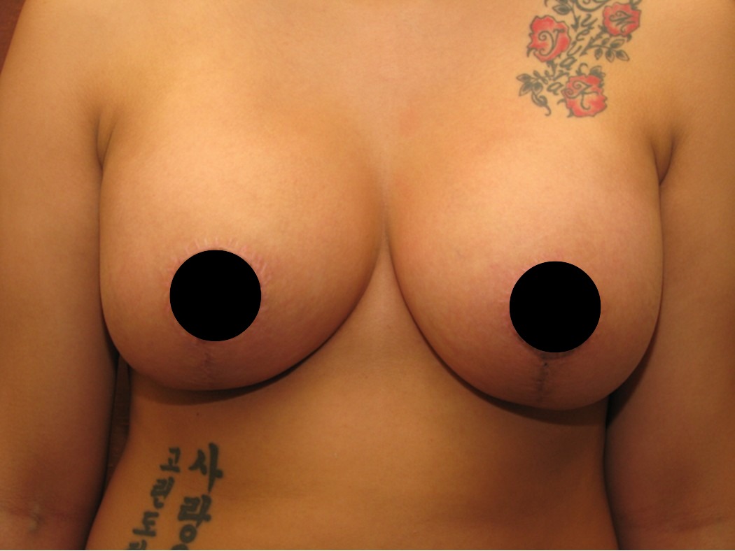 Breast Lift before and after - before