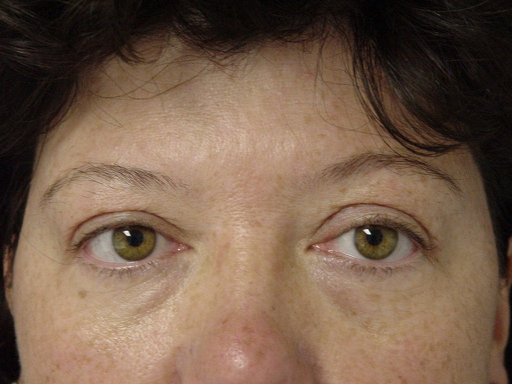 Eyelid Surgery after — Dr. Sayed Mirrafati