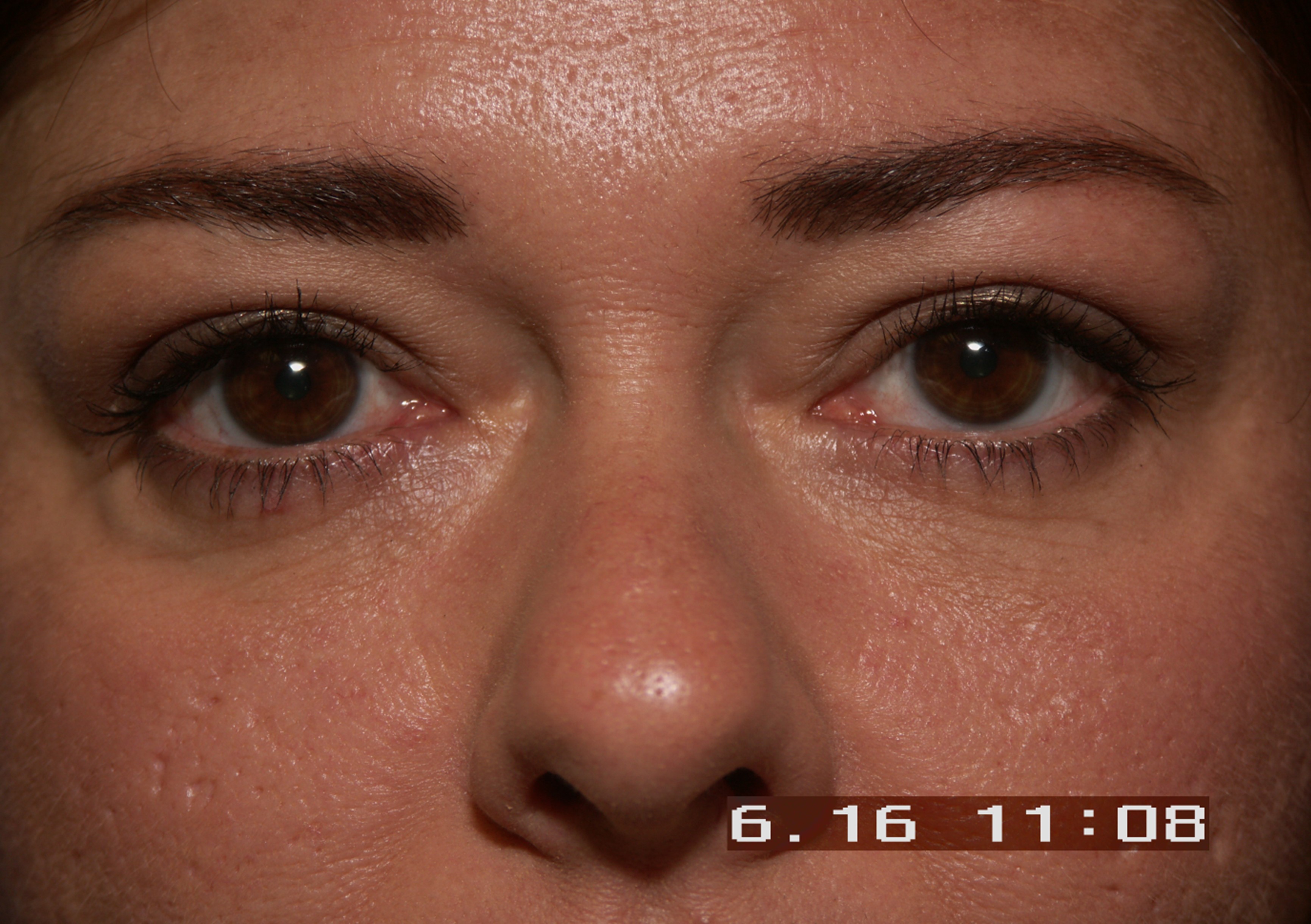 Eyelid Surgery before — Dr. Sayed Mirrafati