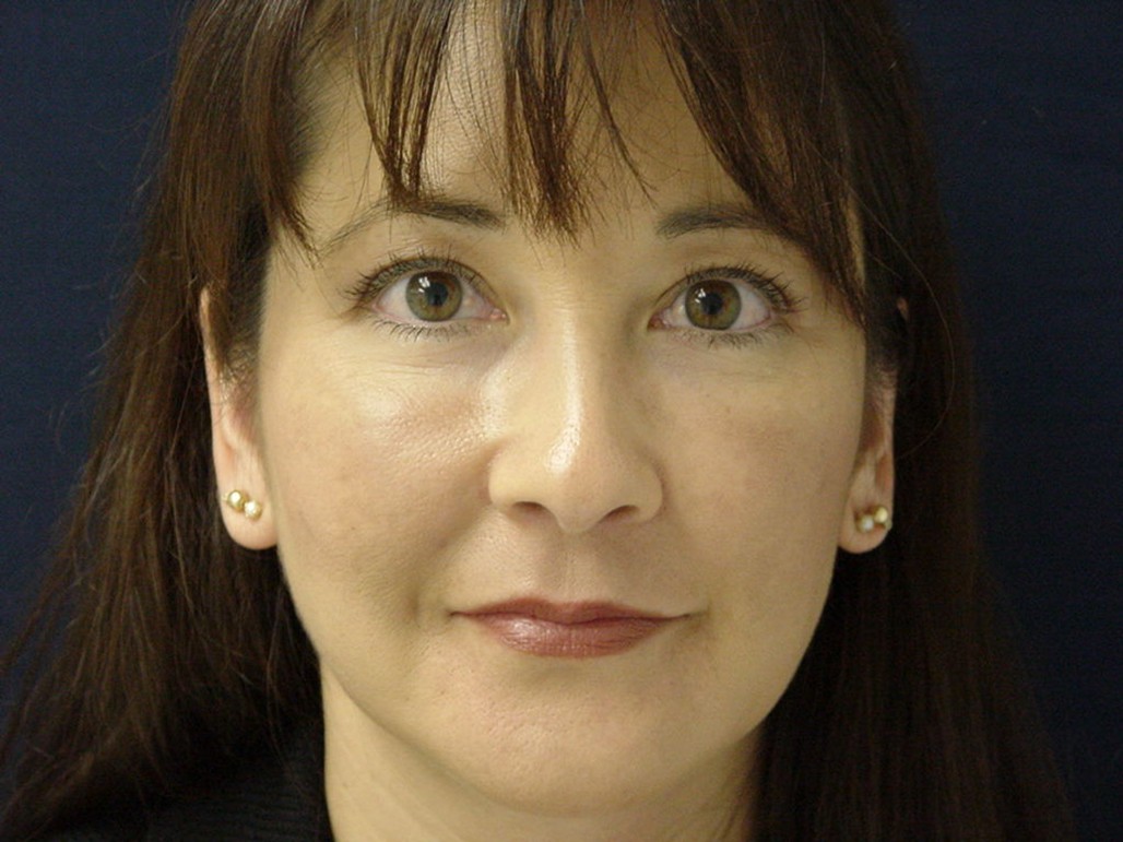 Eyelid Surgery after — Dr. Sayed Mirrafati