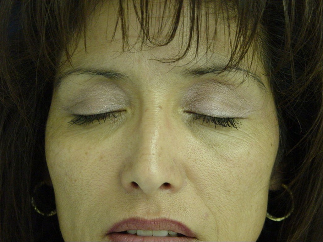 Eyelid Surgery before — Dr. Sayed Mirrafati