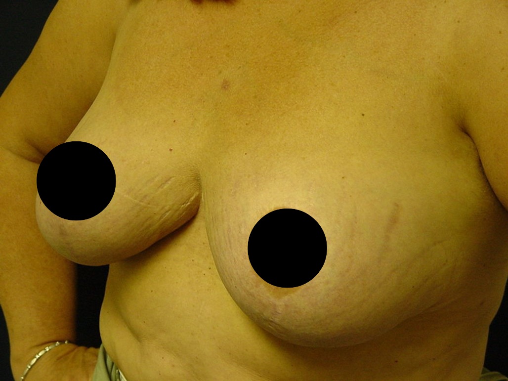 Breast Reduction before and after - after