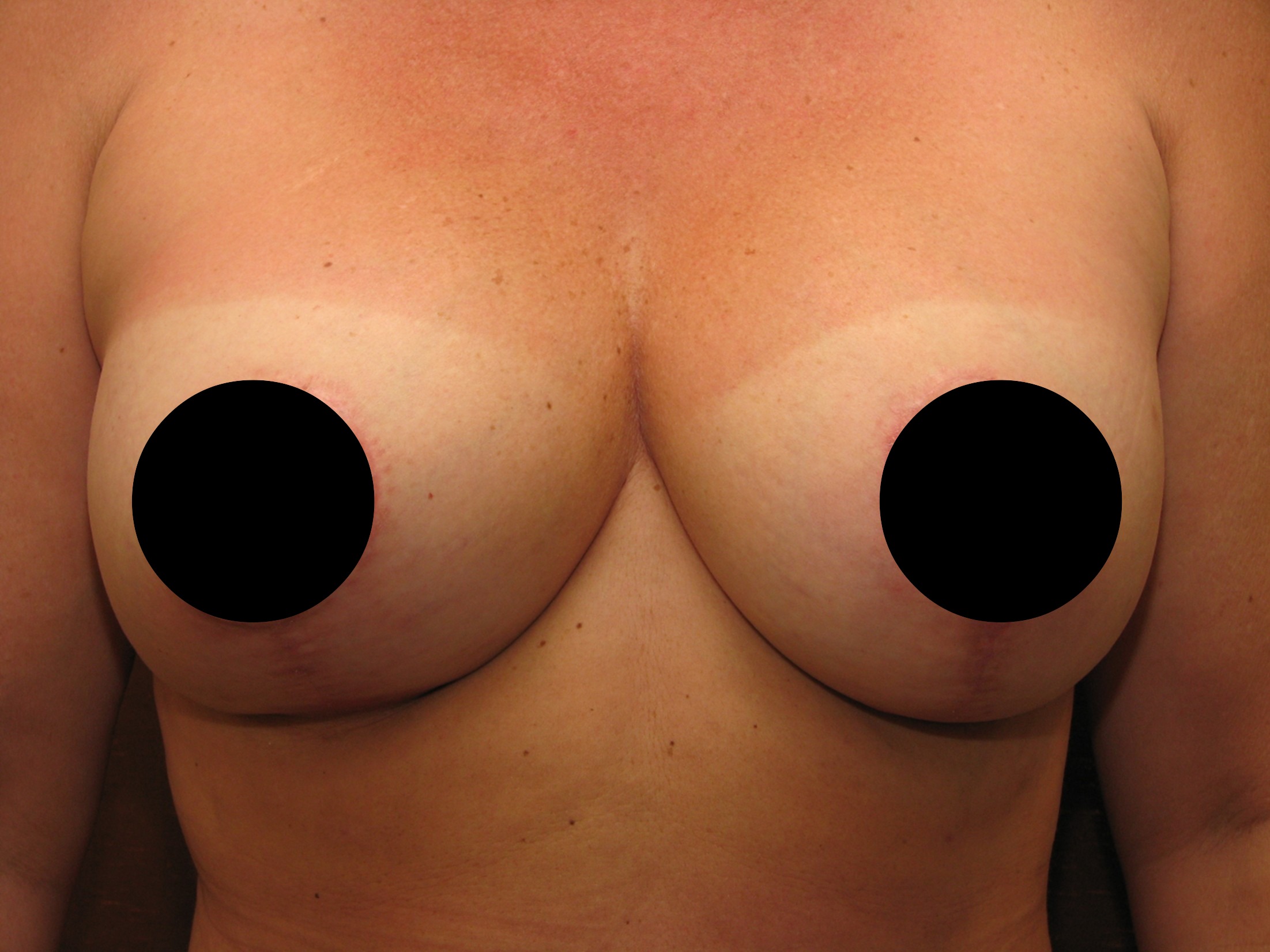 Breast Reduction before and after - before