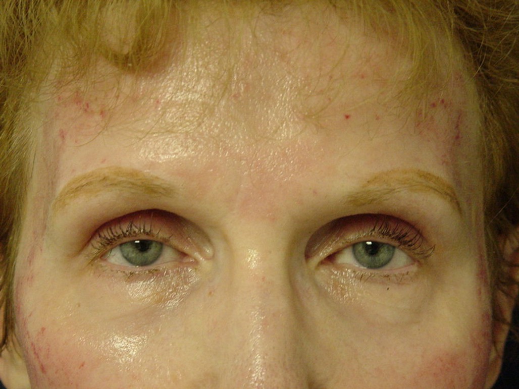 Brow Lift after — Dr. Sayed Mirrafati