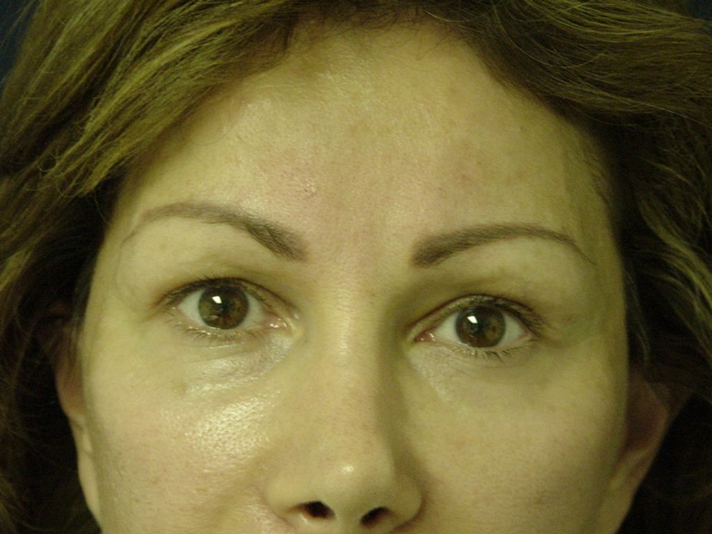 Brow Lift before — Dr. Sayed Mirrafati