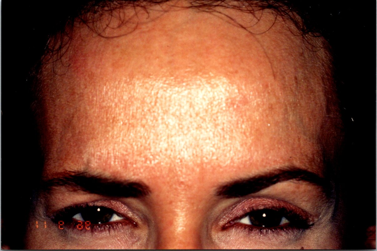 Botox before and after - after