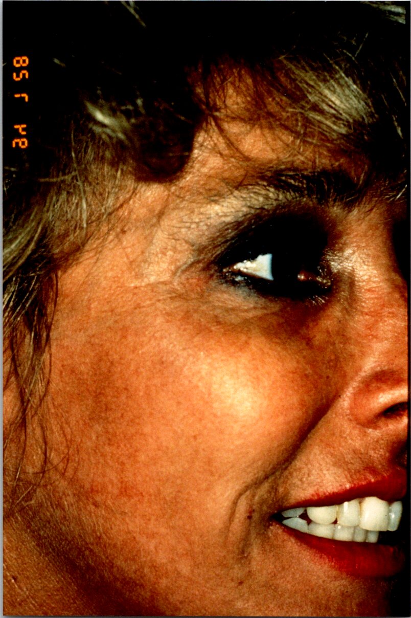 Botox before and after - before