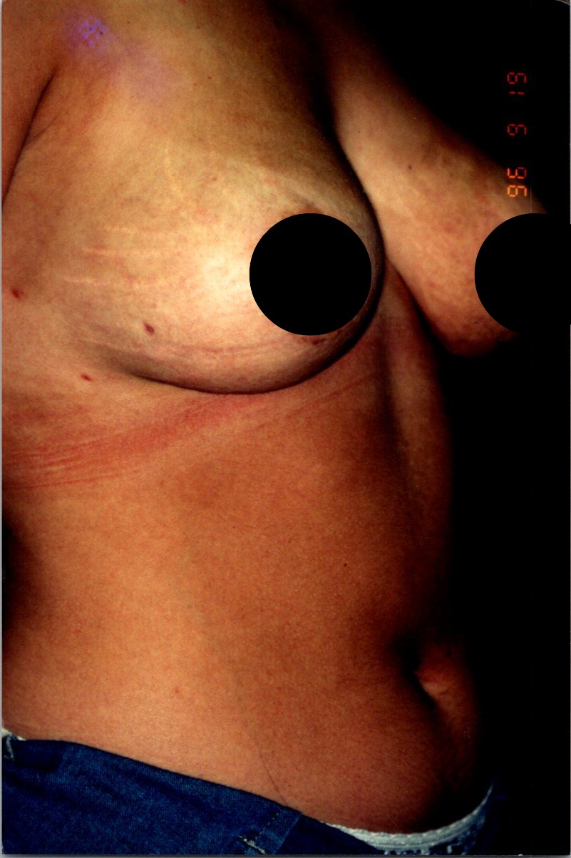 Breast Reduction before and after - before