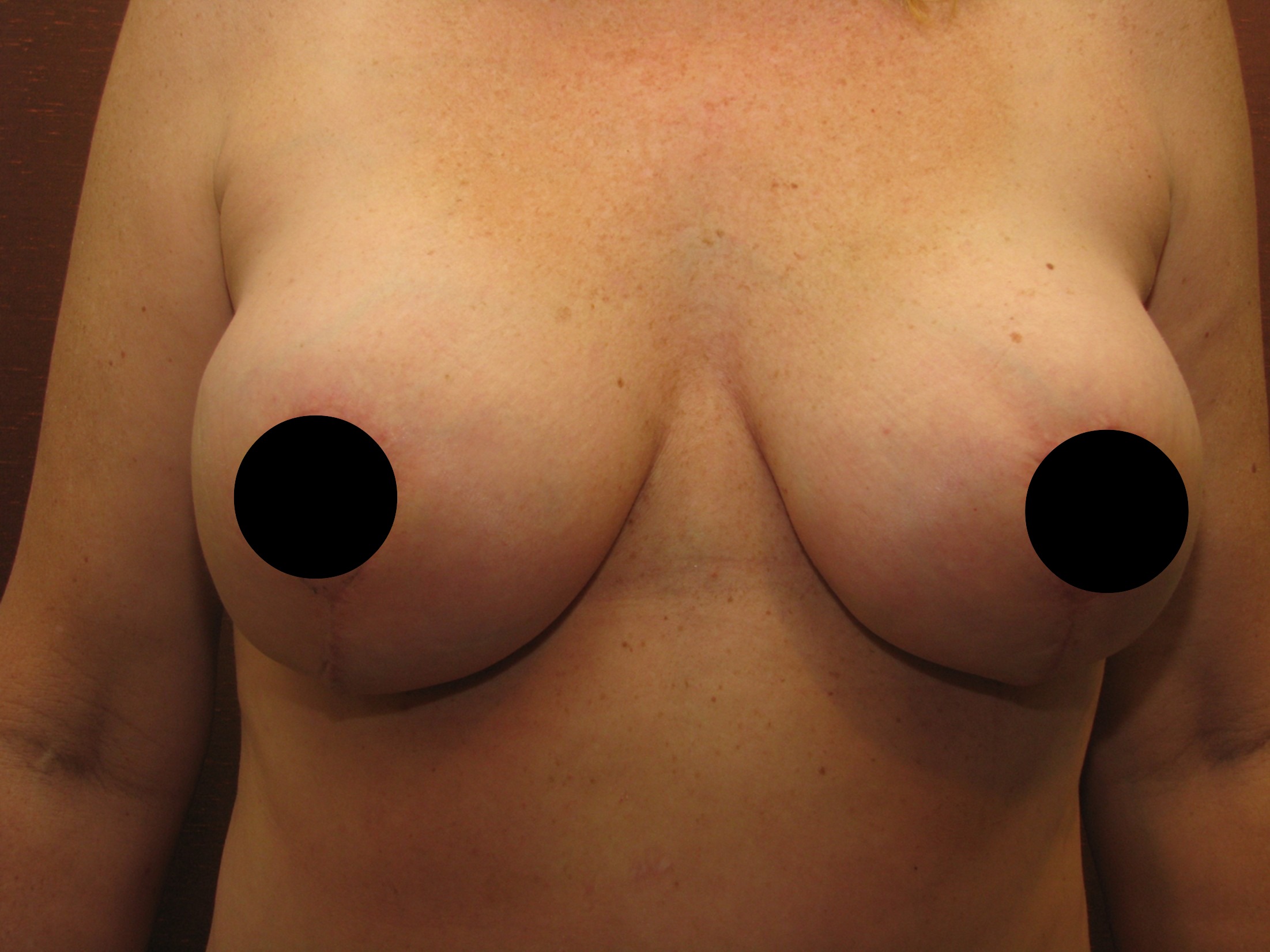 Breast Reduction before and after - after