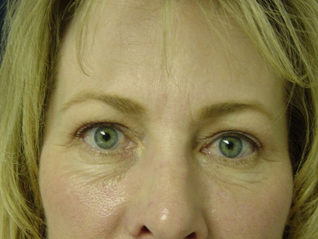 Eyelid Surgery after — Dr. Sayed Mirrafati