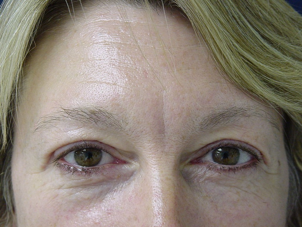 Eyelid Surgery before — Dr. Sayed Mirrafati