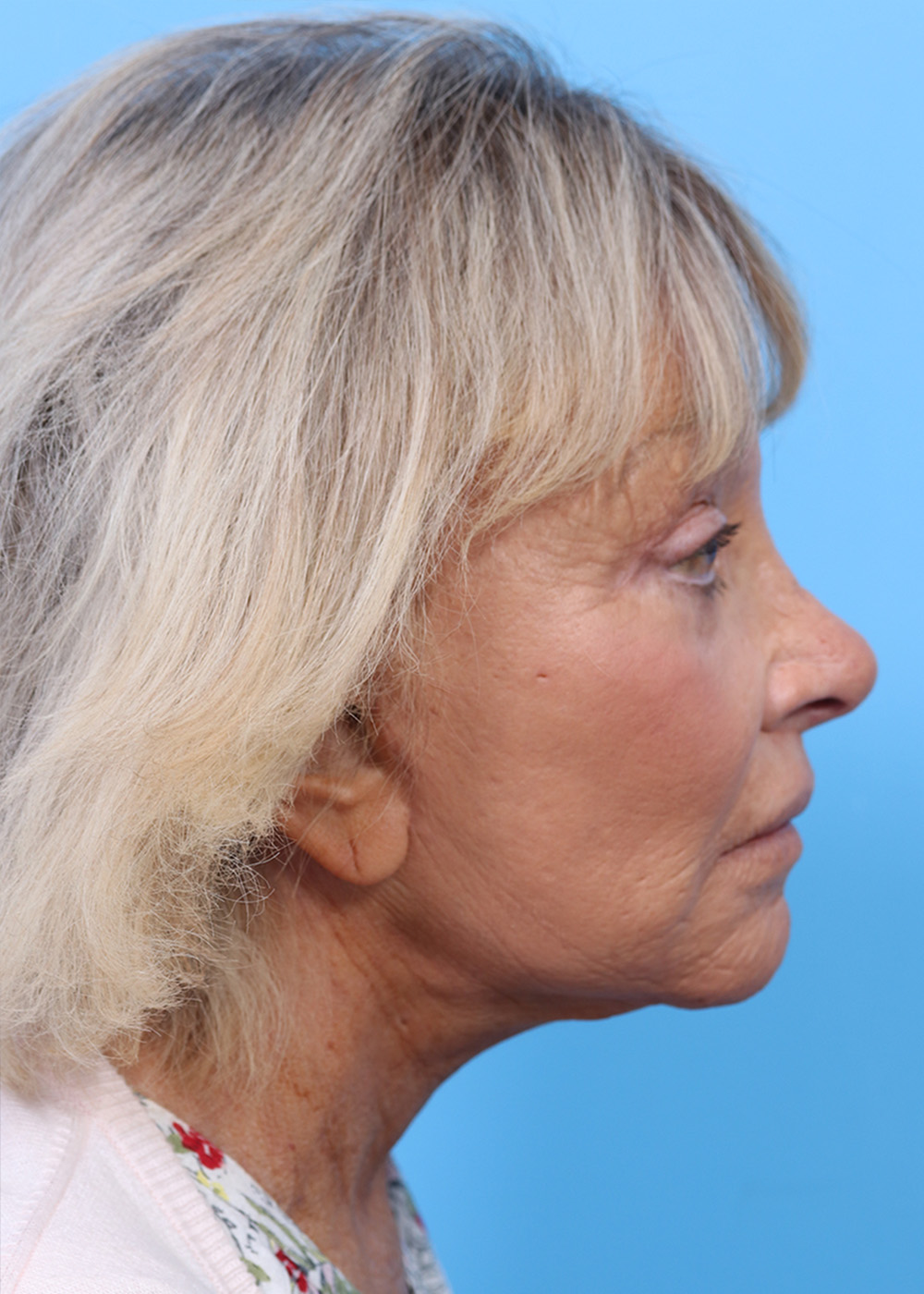 Facelift before and after - after