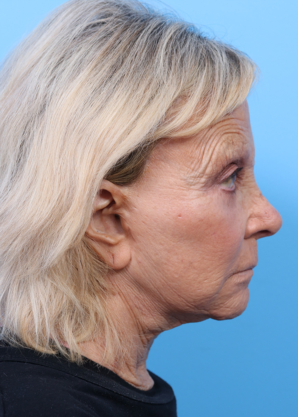 Facelift before and after - before
