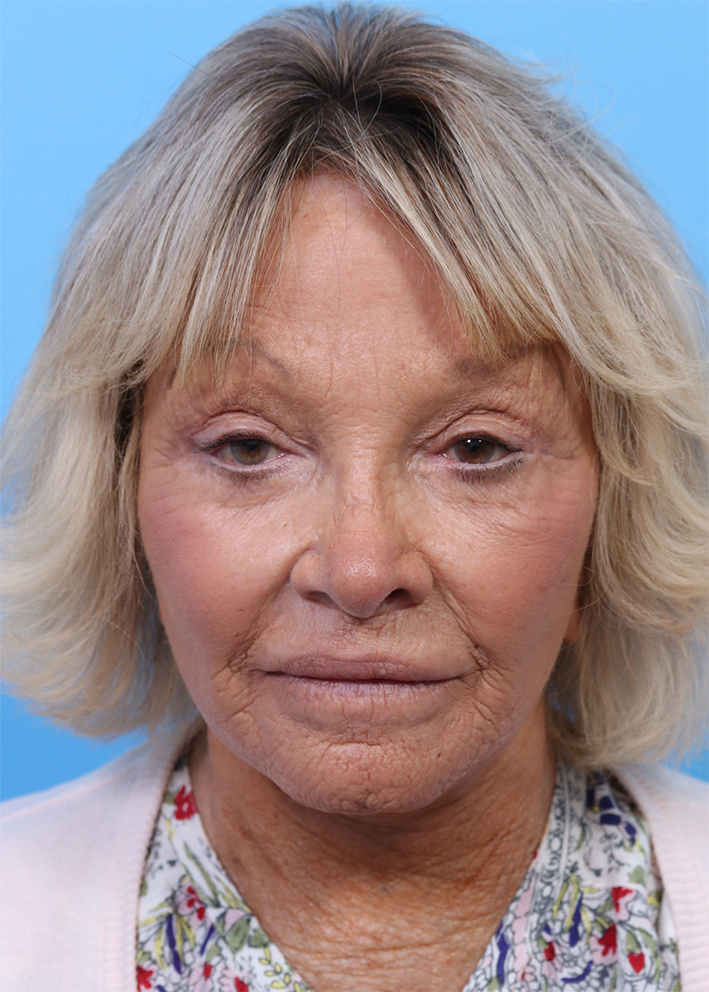 Facelift before and after - after