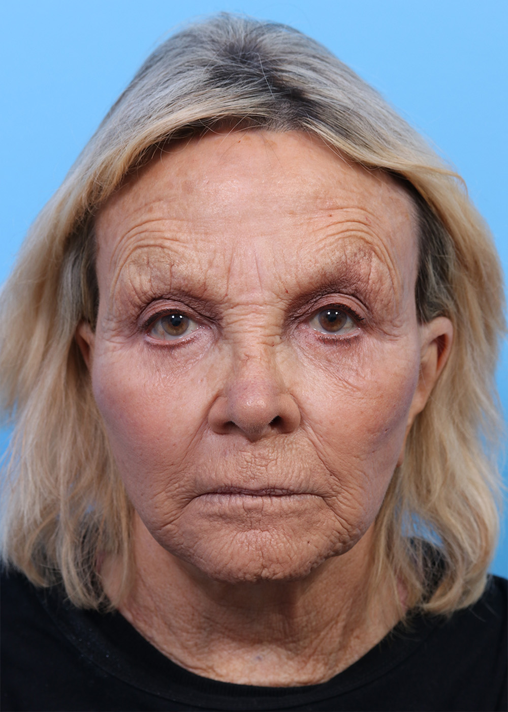Facelift before and after - before