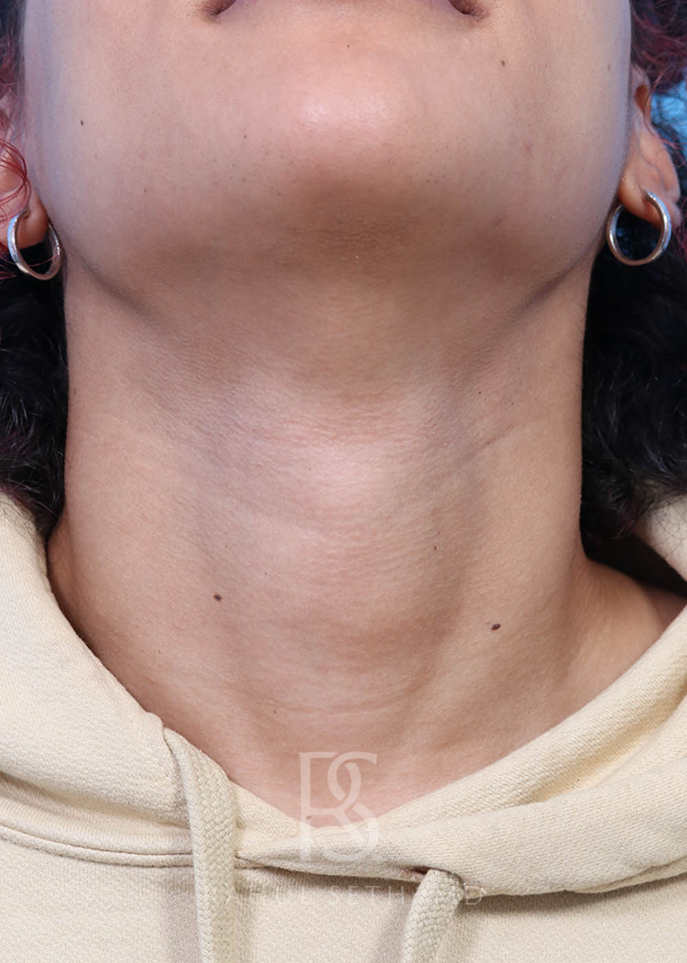 Procedure before and after - after