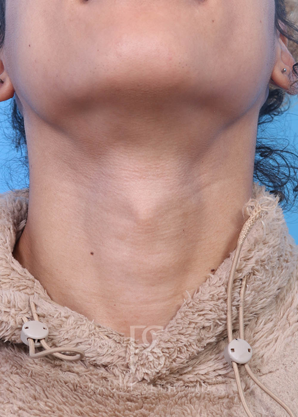 Procedure before and after - before