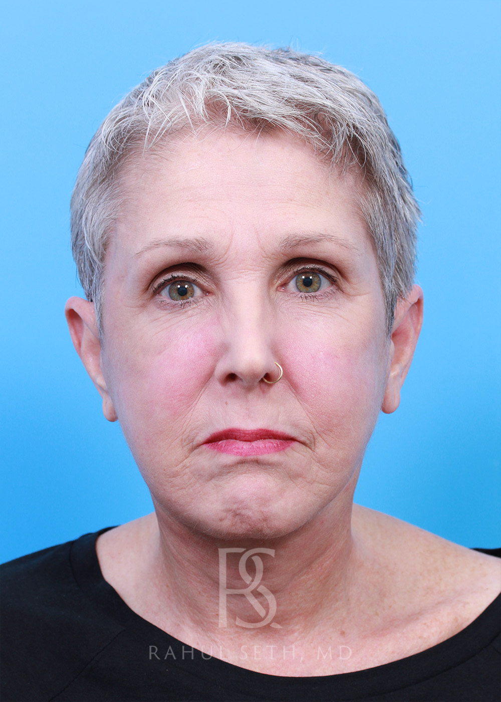Facelift before and after - after