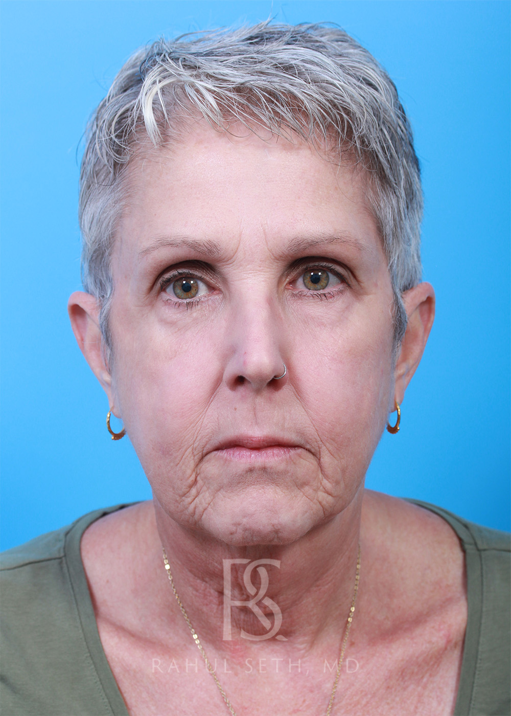 Facelift before and after - before