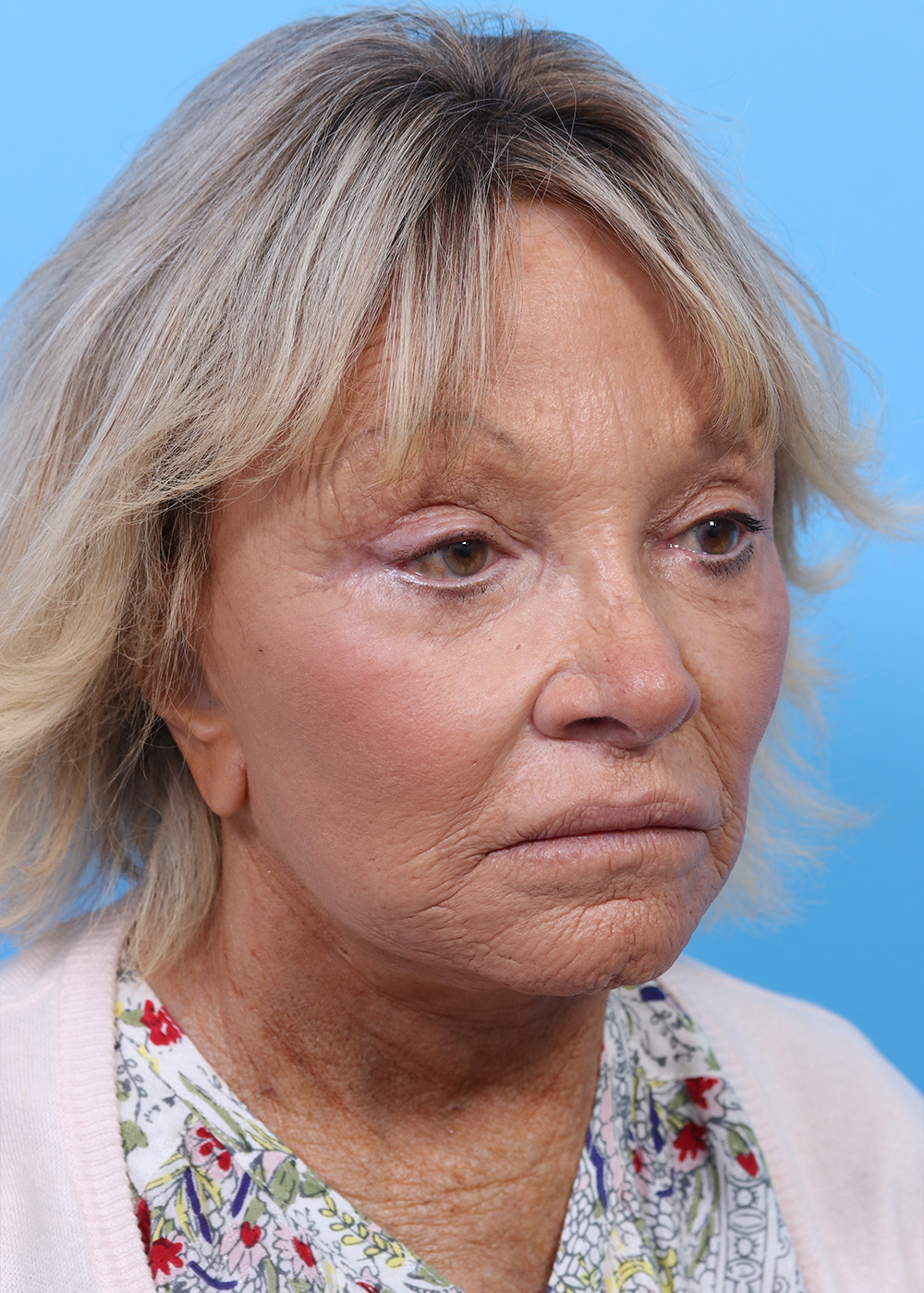 Facelift before and after - after