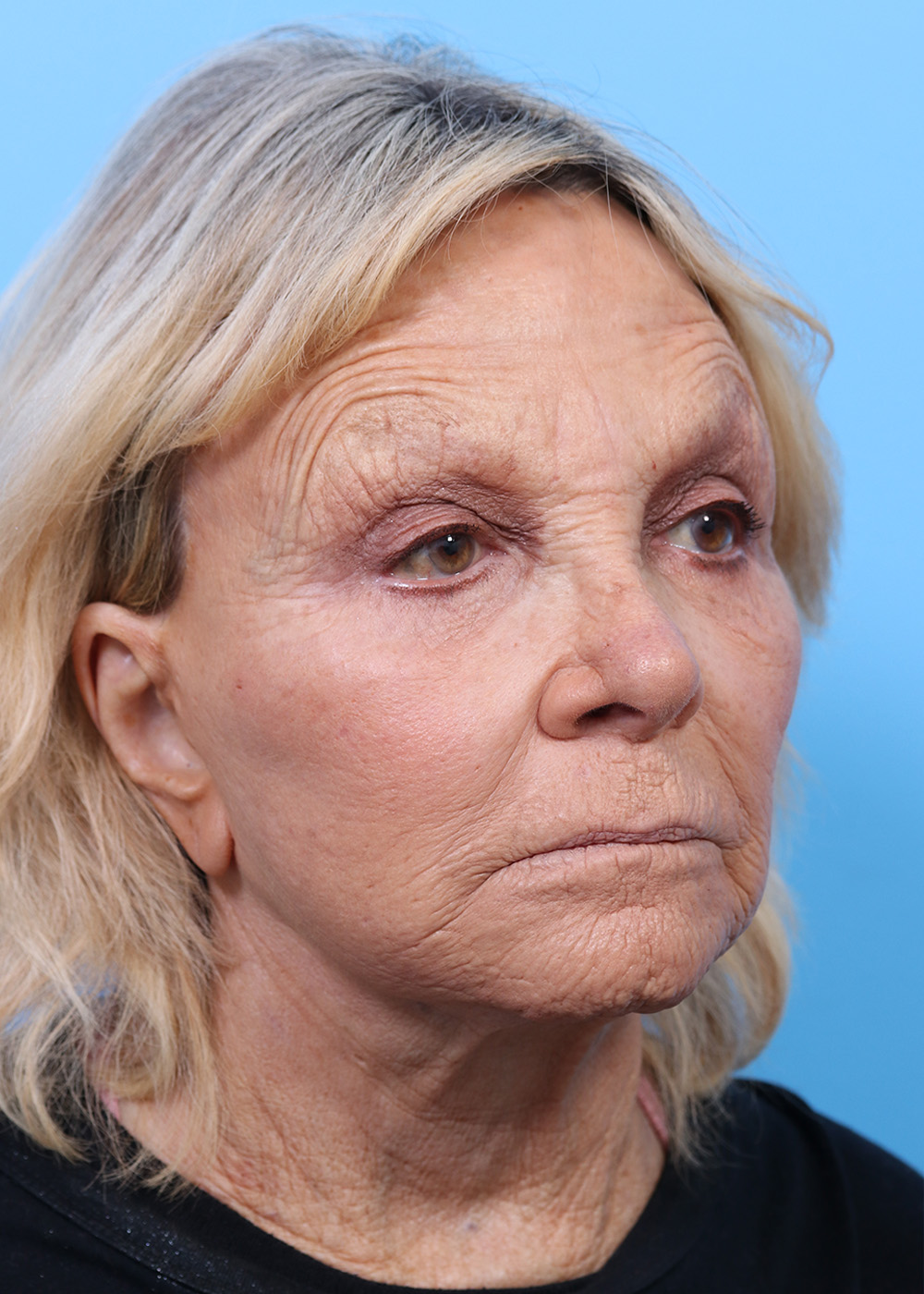 Facelift before and after - before
