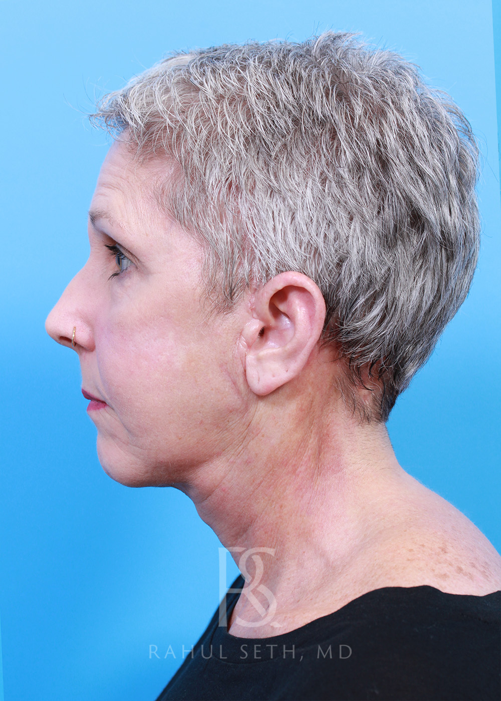 Facelift before and after - after