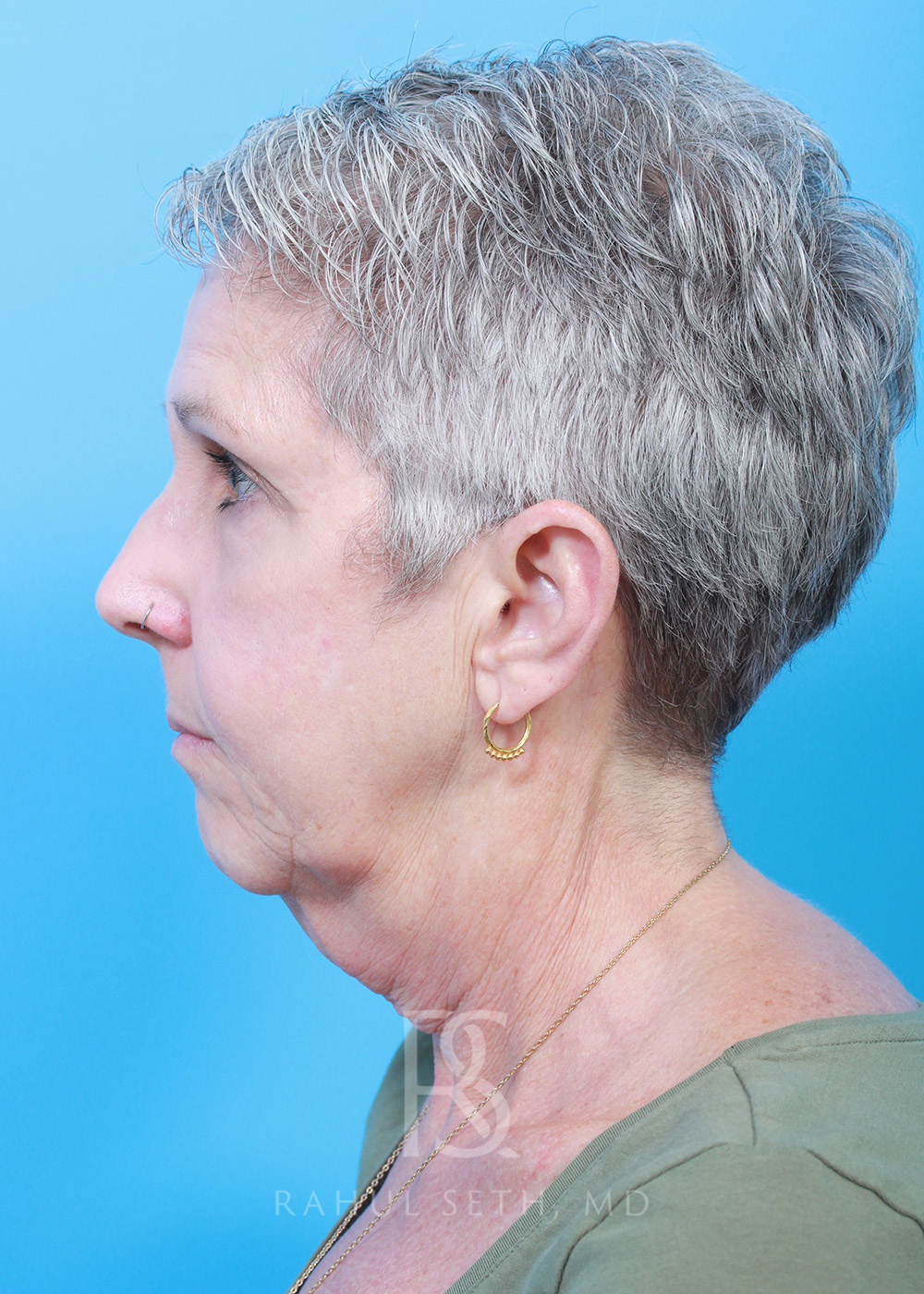 Facelift before and after - before