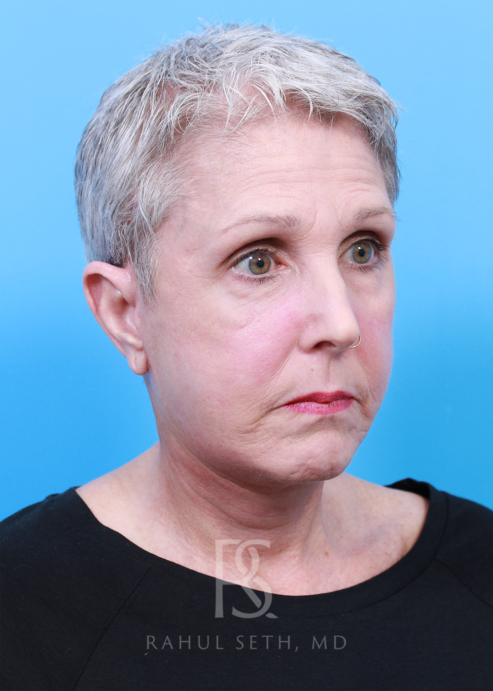 Facelift before and after - after