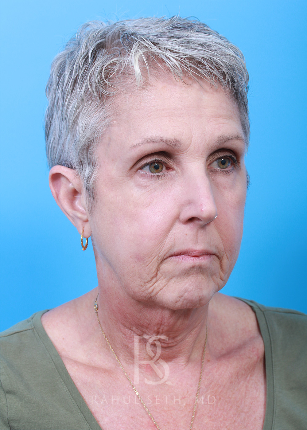 Facelift before and after - before