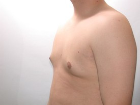 Liposuction after — Dr. Howard Gross