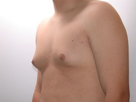 Liposuction before — Dr. Howard Gross