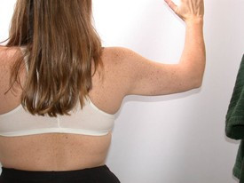 Liposuction before and after - after