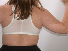 Liposuction before and after - before