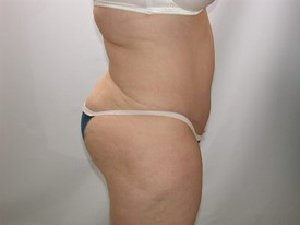 Tummy Tuck after — Dr. Howard Gross