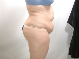 Tummy Tuck before — Dr. Howard Gross