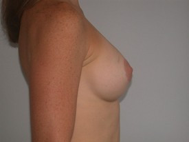 Breast Lift before and after - after