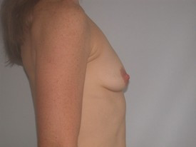 Breast Lift before and after - before