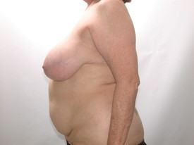 Breast Reduction before and after - before