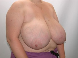 Breast Reduction before and after - before