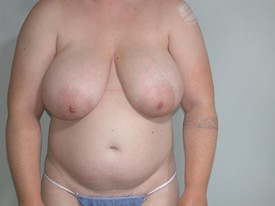Breast Reduction before and after - before